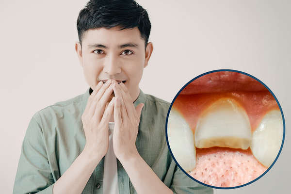 事故で歯を失った