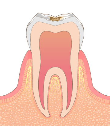 C1（エナメル質の虫歯）のイメージ