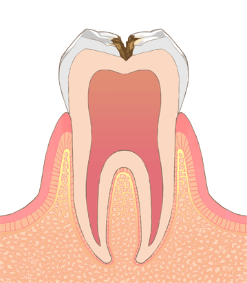 C2（象牙質の虫歯）のイメージ