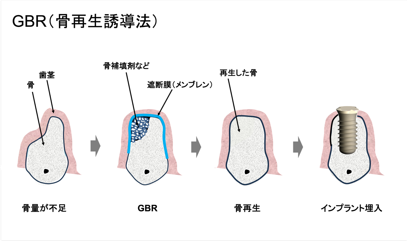 GBRによる骨造成のイメージ