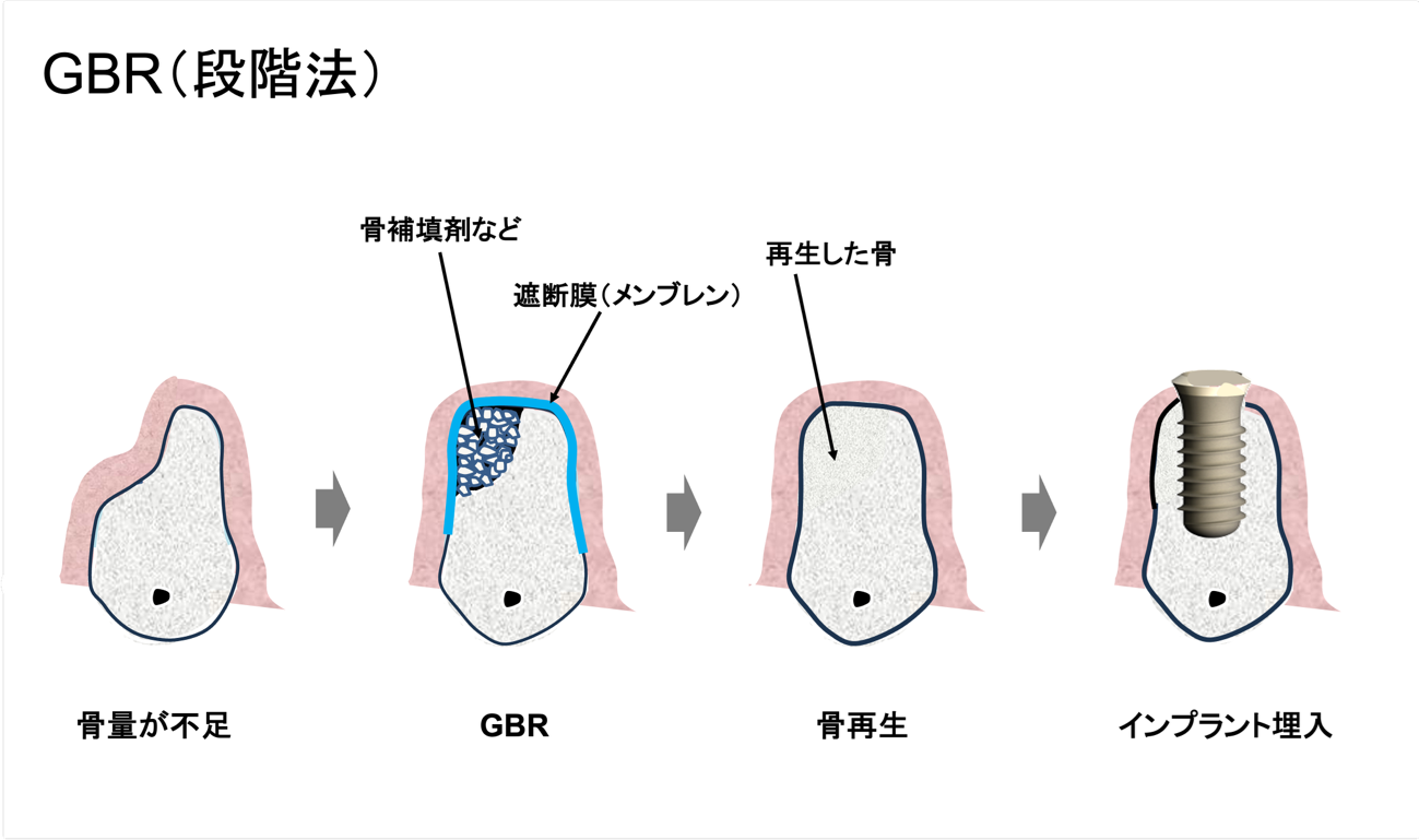 先にGBRを行ってからインプラントを埋入する方法