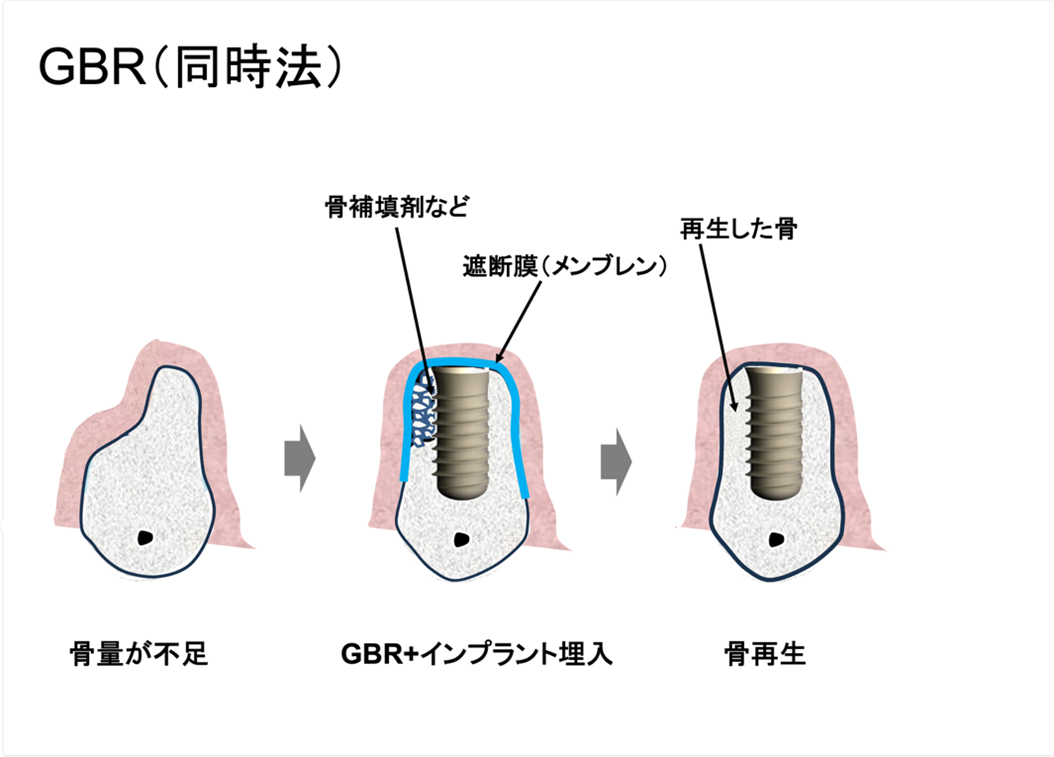 インプラント埋入と同時にGBRを行う方法