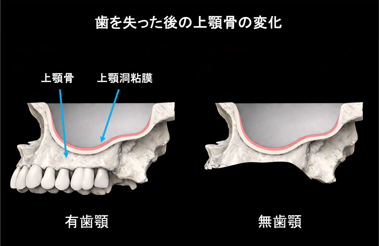 上顎洞底挙上術のイメージ